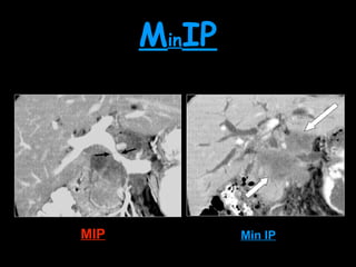 Ct Mini Mip Image Basics of CT | PPT