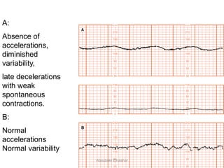 A:
Absence of
accelerations,
diminished
variability,
late decelerations
with weak
spontaneous
contractions.
B:
Normal
accelerations
Normal variability
15 beat
Aboubakr Elnashar
 