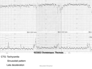 CTG: Tachycardia
Sinusoidal pattern
Late deceleration Aboubakr Elnashar
 