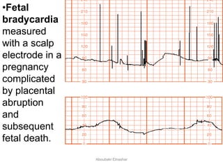 •Fetal
bradycardia
measured
with a scalp
electrode in a
pregnancy
complicated
by placental
abruption
and
subsequent
fetal death.
Aboubakr Elnashar
 