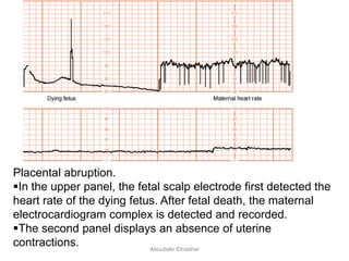Placental abruption.
In the upper panel, the fetal scalp electrode first detected the
heart rate of the dying fetus. After fetal death, the maternal
electrocardiogram complex is detected and recorded.
The second panel displays an absence of uterine
contractions. Aboubakr Elnashar
 