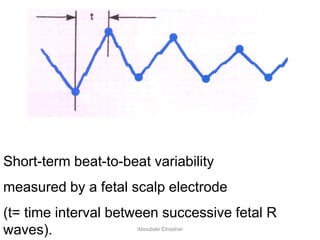 Short-term beat-to-beat variability
measured by a fetal scalp electrode
(t= time interval between successive fetal R
waves). Aboubakr Elnashar
 