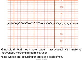 •Sinusoidal fetal heart rate pattern associated with maternal
intravenous meperidine administration.
•Sine waves are occurring at arate of 6 cycles/min.
Aboubakr Elnashar
 