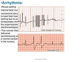 •Arrhythmia:
•Abrupt spiking
Internal fetal monitoring:
•occasional abrupt beat-
to-beat fetal heart rate
spiking due to erratic
exrasystoles shown in
the superimposed fetal
electrocardiogram.
•The normal infant was
delivered
spontaneously and had
a normal cardiac rhythm
in the nursery.
Aboubakr Elnashar
 