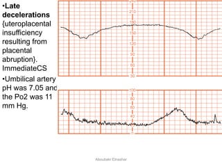 •Late
decelerations
{uteroplacental
insufficiency
resulting from
placental
abruption}.
ImmediateCS
•Umbilical artery
pH was 7.05 and
the Po2 was 11
mm Hg.
Aboubakr Elnashar
 