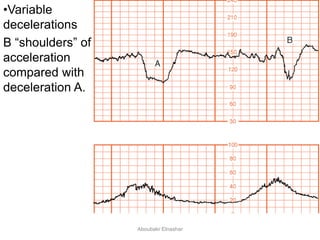 •Variable
decelerations
B “shoulders” of
acceleration
compared with
deceleration A.
Aboubakr Elnashar
 