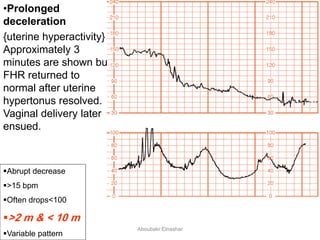 Abrupt decrease
>15 bpm
Often drops<100
>2 m & < 10 m
Variable pattern
•Prolonged
deceleration
{uterine hyperactivity}
Approximately 3
minutes are shown but
FHR returned to
normal after uterine
hypertonus resolved.
Vaginal delivery later
ensued.
Aboubakr Elnashar
 