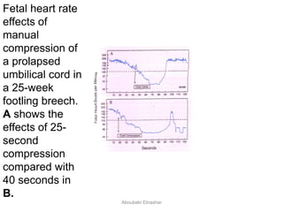 Fetal heart rate
effects of
manual
compression of
a prolapsed
umbilical cord in
a 25-week
footling breech.
A shows the
effects of 25-
second
compression
compared with
40 seconds in
B.
Aboubakr Elnashar
 