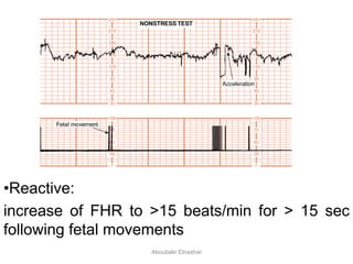 •Reactive:
increase of FHR to >15 beats/min for > 15 sec
following fetal movements
Aboubakr Elnashar
 
