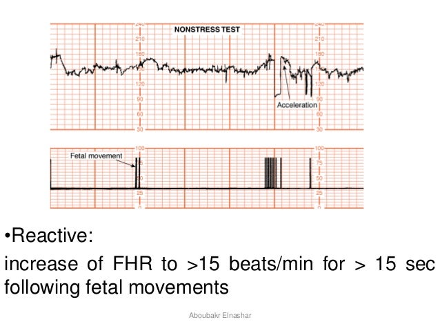 test heart beat e intrapartum and antepartum CTG Cardiotocography: test heart beat e intrapartum and antepartum CTG Cardiotocography: