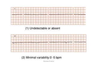 Cardiotocography | PPTX