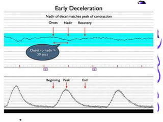 Cardiotocography | PPTX