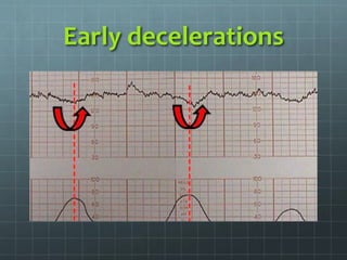 Early decelerations
 