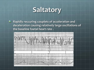 Saltatory
Rapidly reccuring couplets of acceleration and
deceleration causing relatively large oscillations of
the baseline foetal heart rate .
 