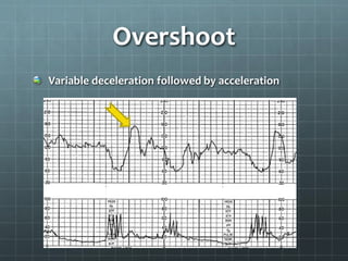Overshoot
Variable deceleration followed by acceleration
 