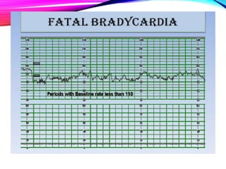 ELECTRONIC FETAL MONITORING CARDIOTOCOGRAPH IN THE MANAGEMENT OF LABOUR ...
