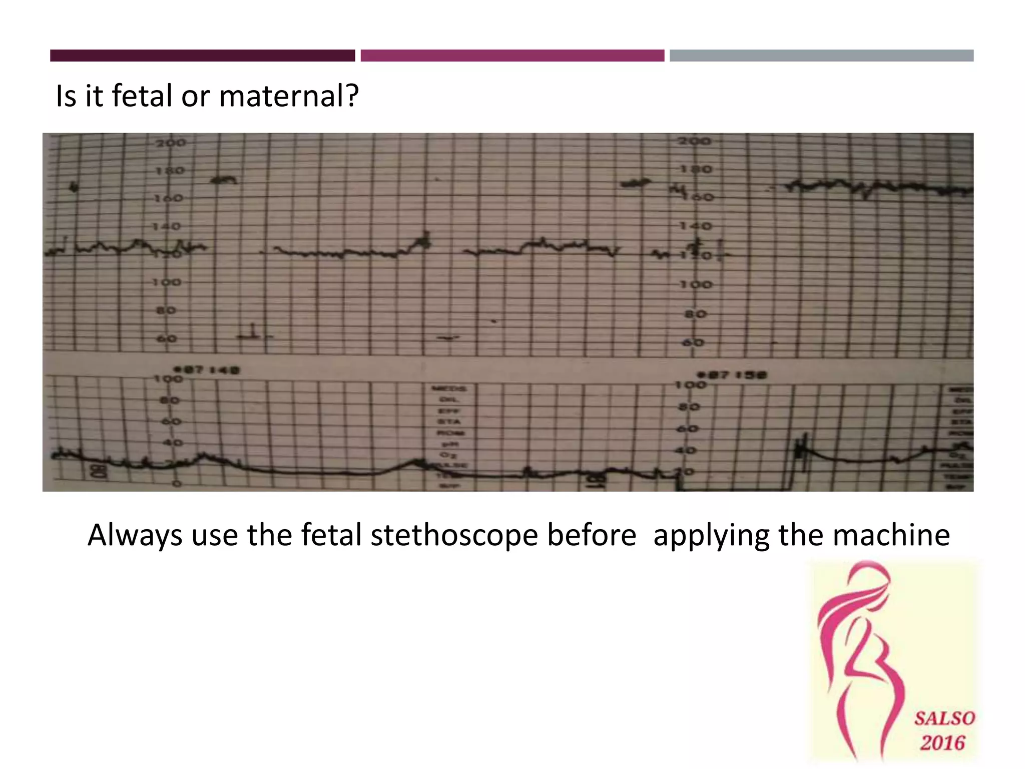 Is it fetal or maternal?
Always use the fetal stethoscope before applying the machine
 