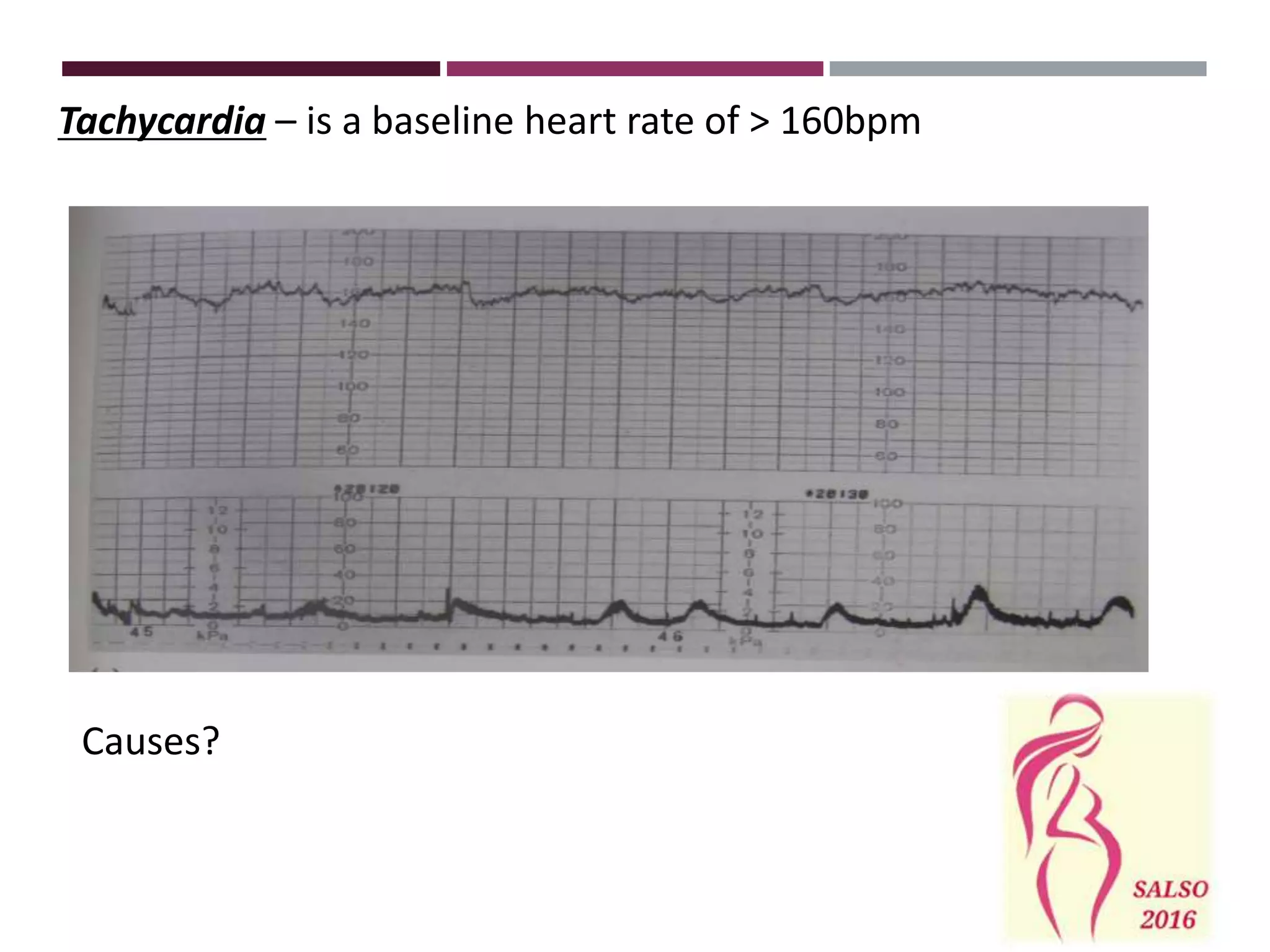 Tachycardia – is a baseline heart rate of > 160bpm
Causes?
 