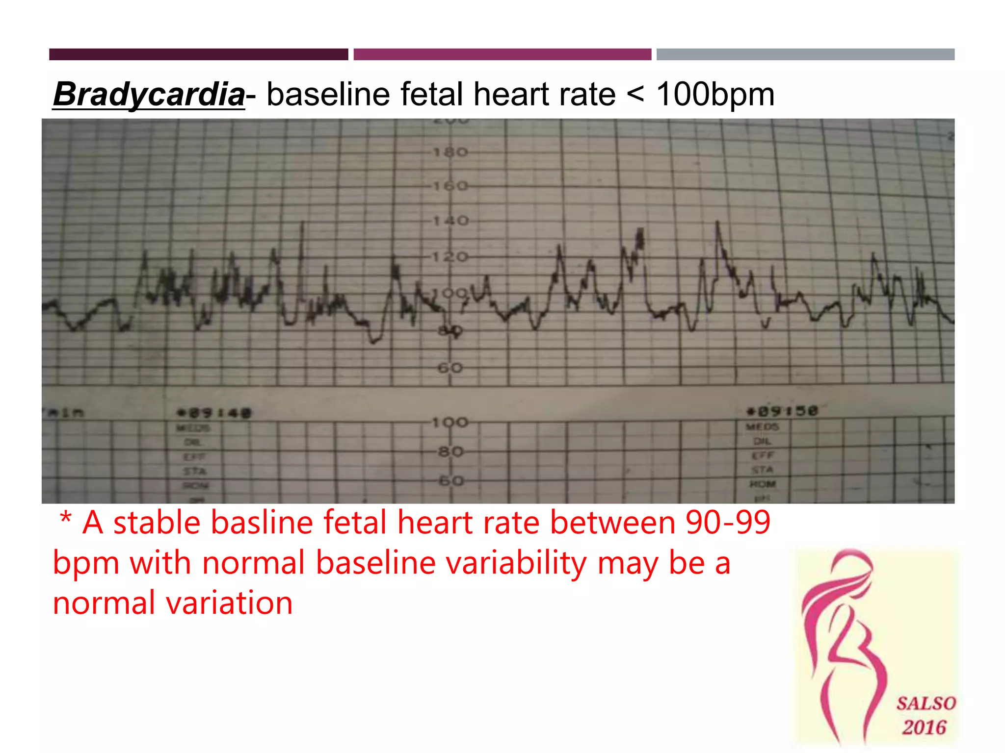 Bradycardia- baseline fetal heart rate < 100bpm
* A stable basline fetal heart rate between 90-99
bpm with normal baseline variability may be a
normal variation
 