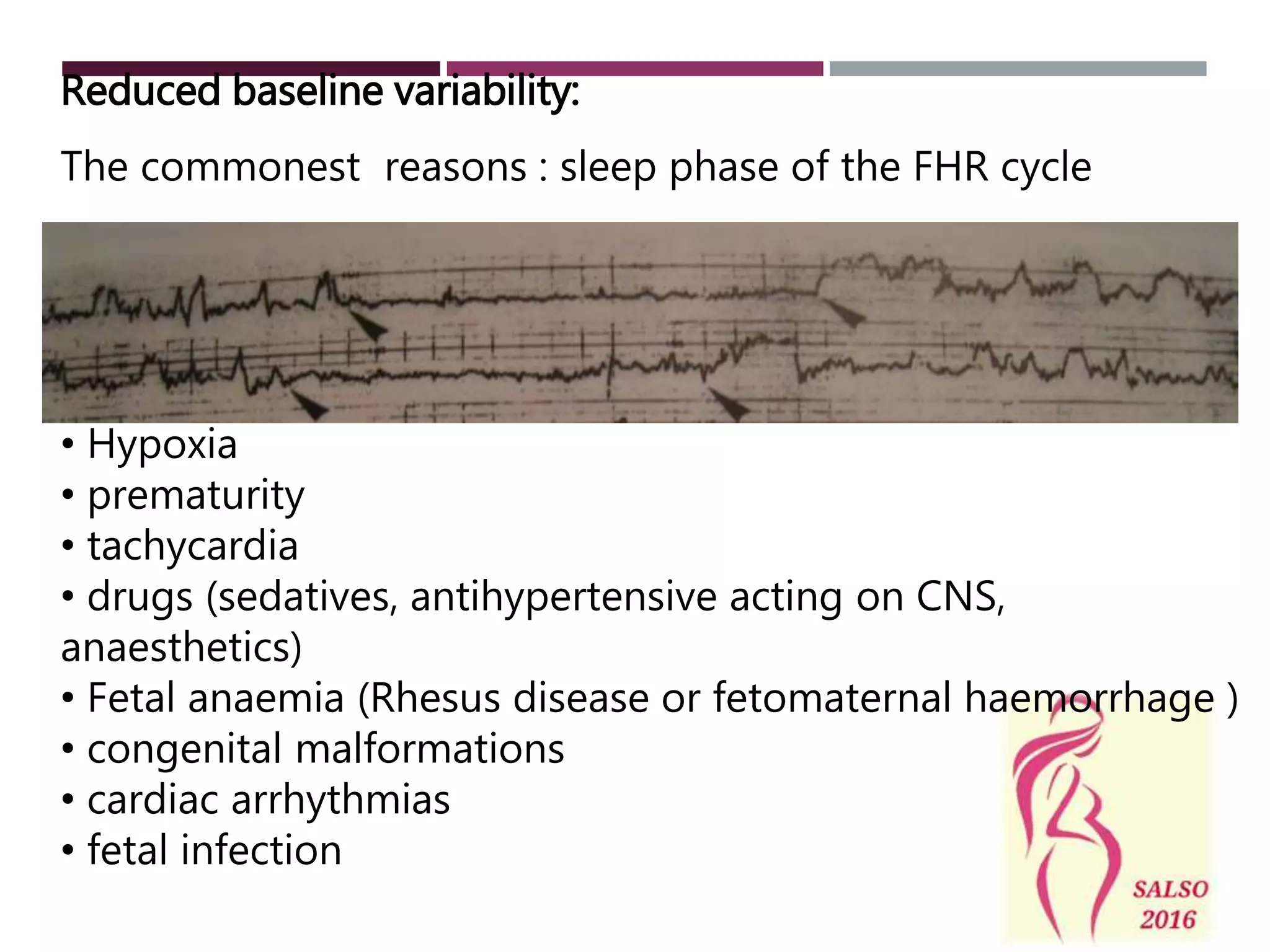 Reduced baseline variability:
The commonest reasons : sleep phase of the FHR cycle
• Hypoxia
• prematurity
• tachycardia
• drugs (sedatives, antihypertensive acting on CNS,
anaesthetics)
• Fetal anaemia (Rhesus disease or fetomaternal haemorrhage )
• congenital malformations
• cardiac arrhythmias
• fetal infection
 