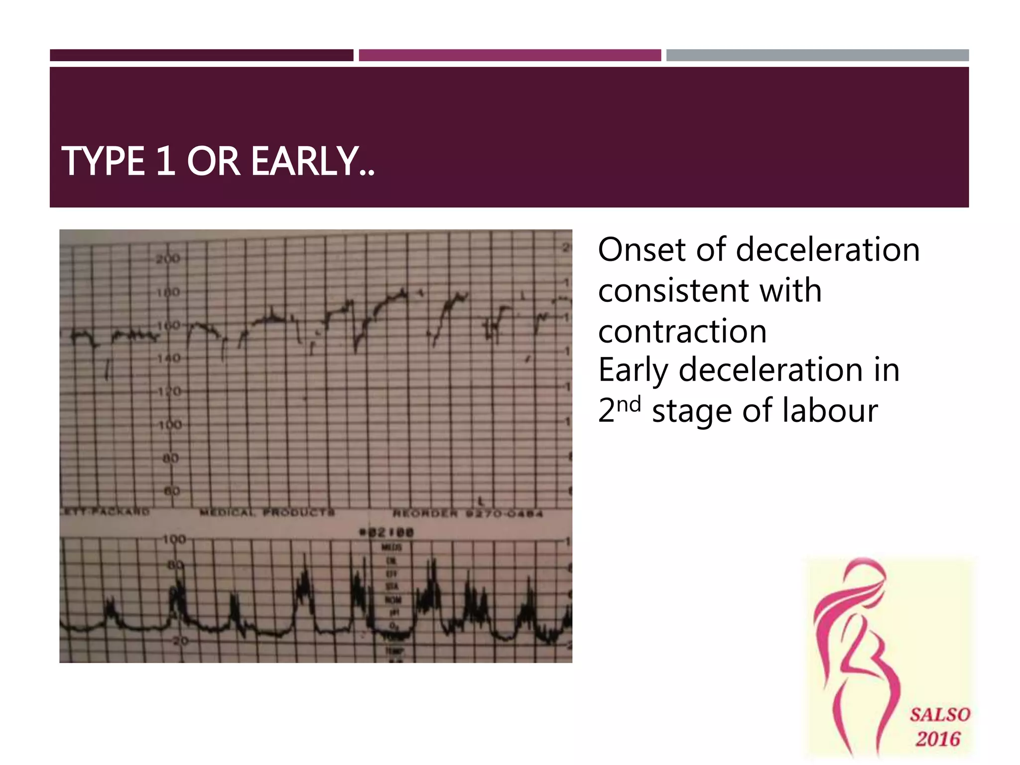 Early deceleration in
2nd stage of labour
TYPE 1 OR EARLY..
Onset of deceleration
consistent with
contraction
 