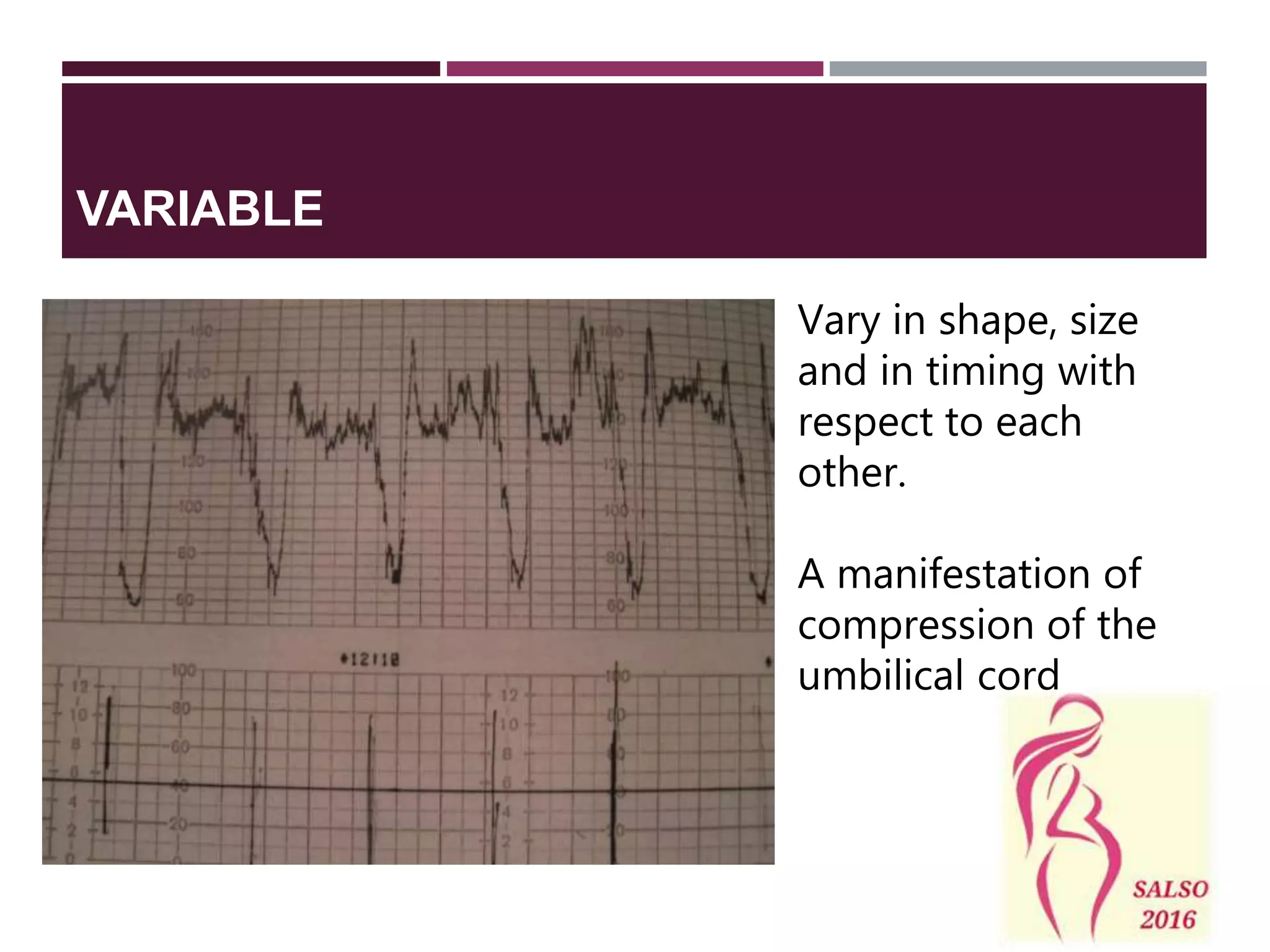 Vary in shape, size
and in timing with
respect to each
other.
A manifestation of
compression of the
umbilical cord
VARIABLE
 
