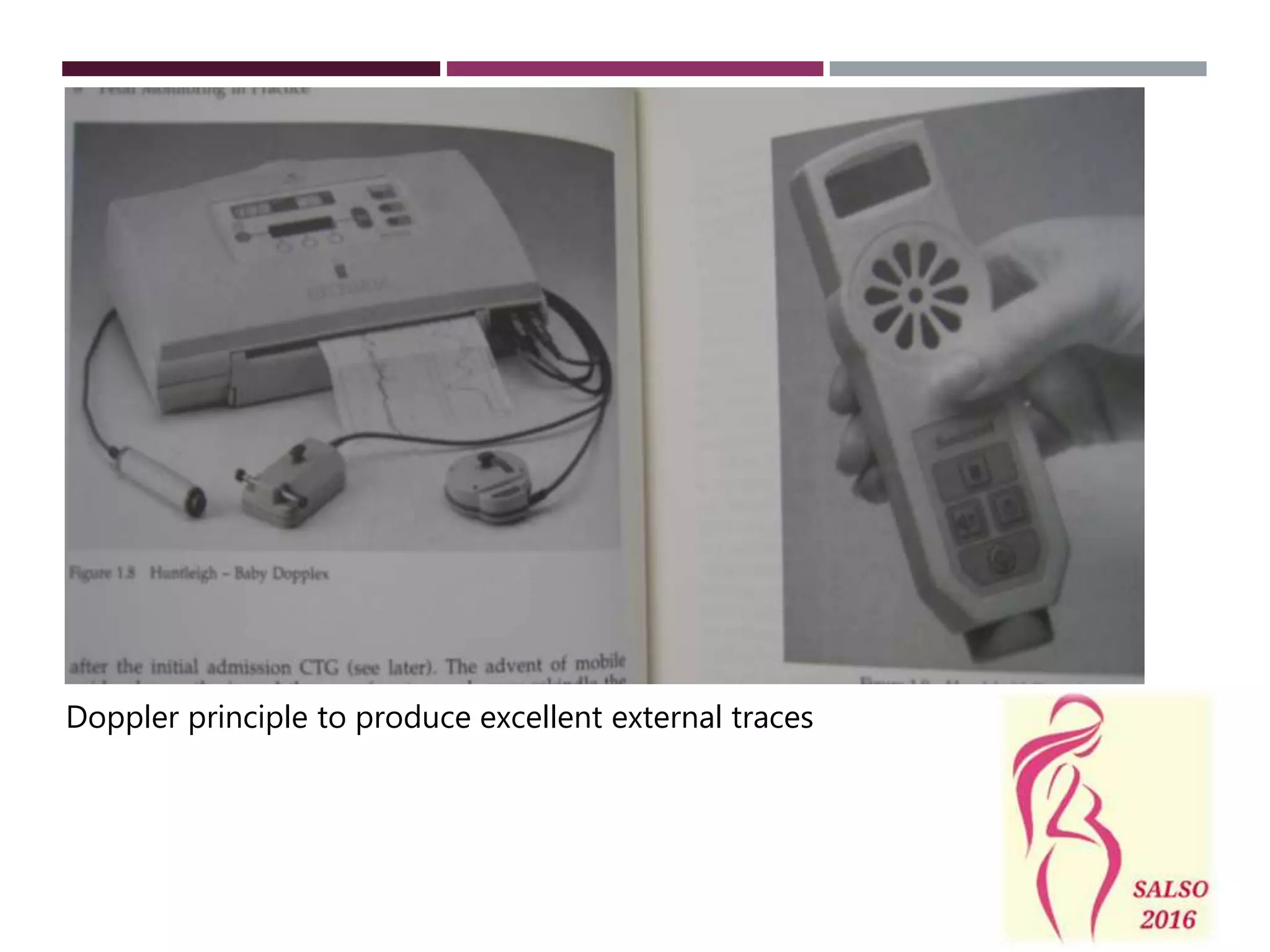 Doppler principle to produce excellent external traces
 