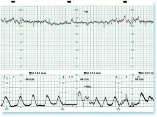 Nice Ctg Interpretation Guide.pdf Comprehensive Guide to Cardiotocography (CTG) Interpretation and Fetal ...