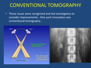 CONVENTIONAL TOMOGRAPHY
• These issues were recognized and led investigators to
consider improvements . One such innovation was
conventional tomography .
 
