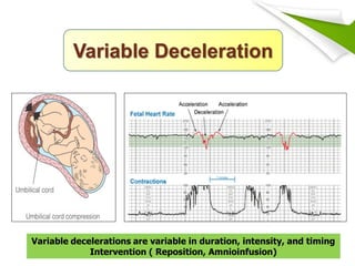 Electronic Fetal Heart Rate Monitoring for Nursing students | PDF