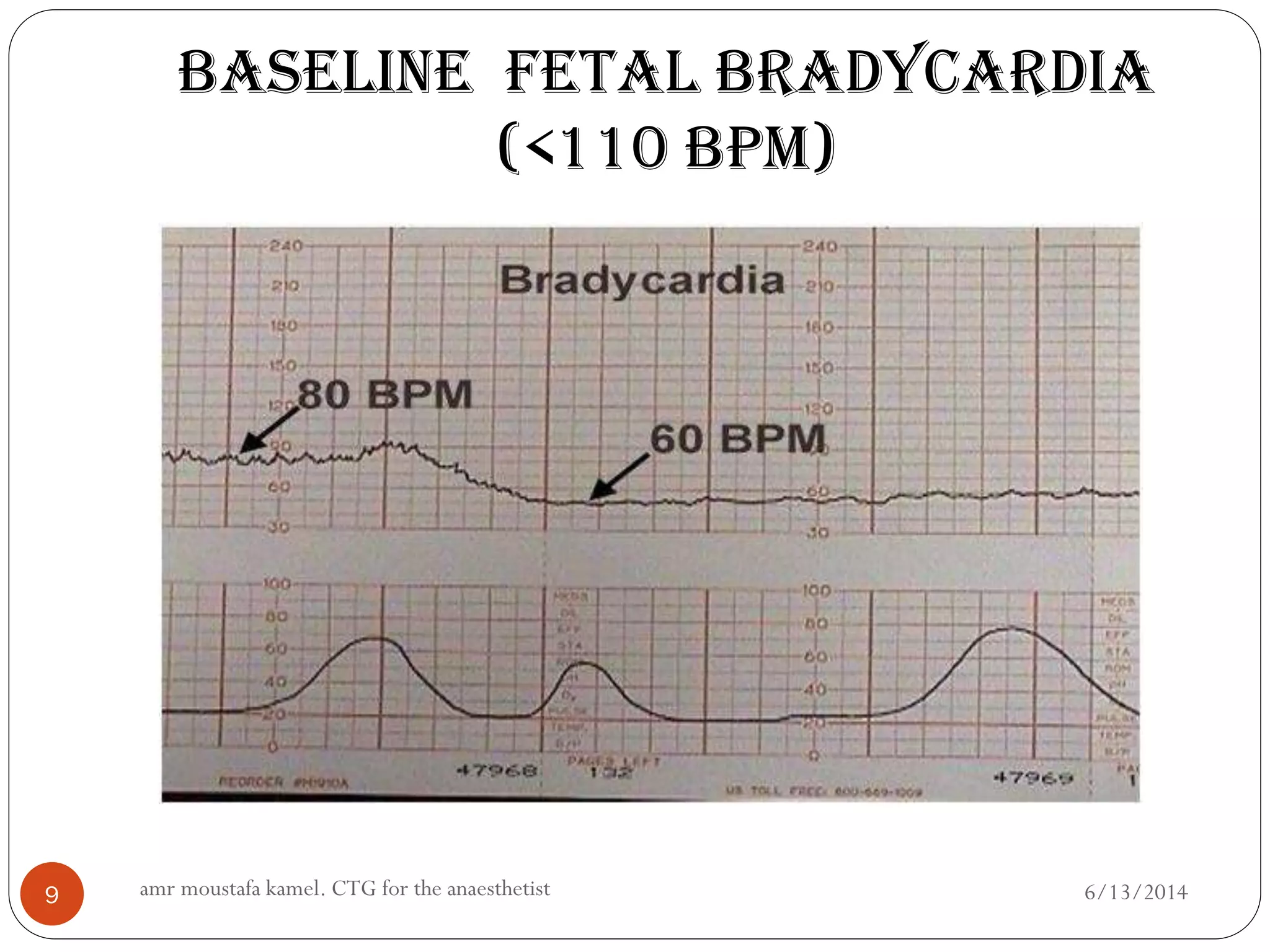 CTG for the anaesthetist | PPTX
