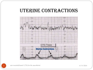 CTG for the anaesthetist | PPTX