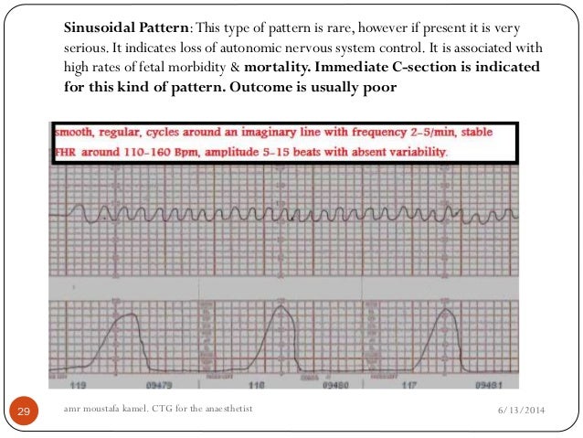 CTG for the anaesthetist