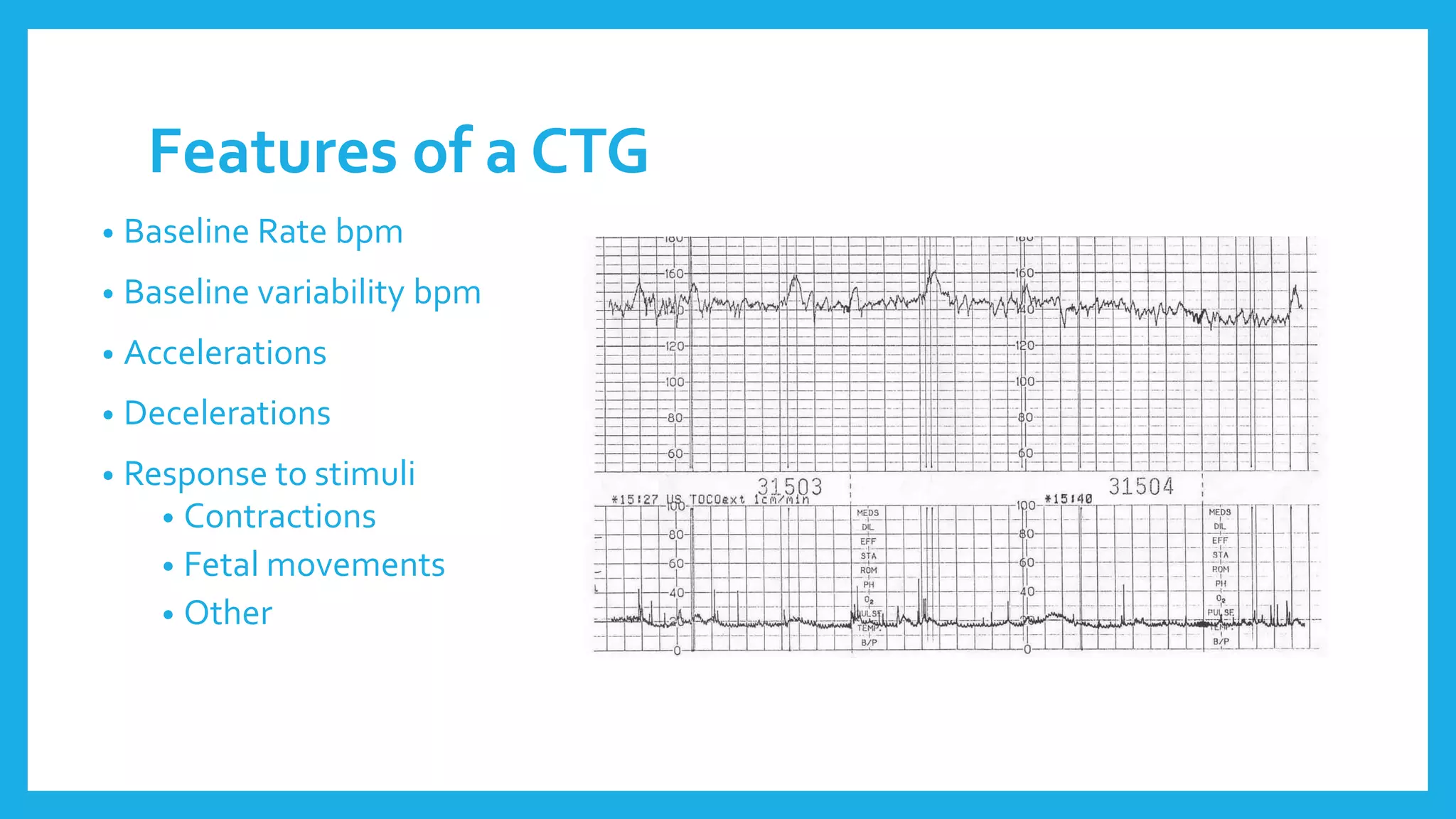 Features of a CTG
• Baseline Rate bpm
• Baseline variability bpm
• Accelerations
• Decelerations
• Response to stimuli
• Contractions
• Fetal movements
• Other
 