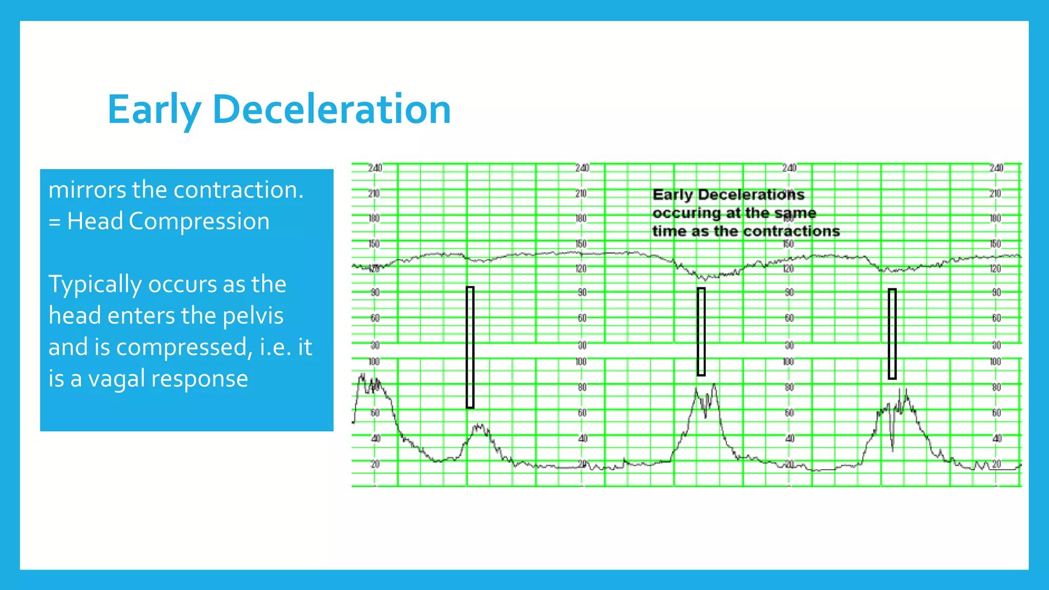 Early Deceleration
mirrors the contraction.
= Head Compression
Typically occurs as the
head enters the pelvis
and is compressed, i.e. it
is a vagal response
 