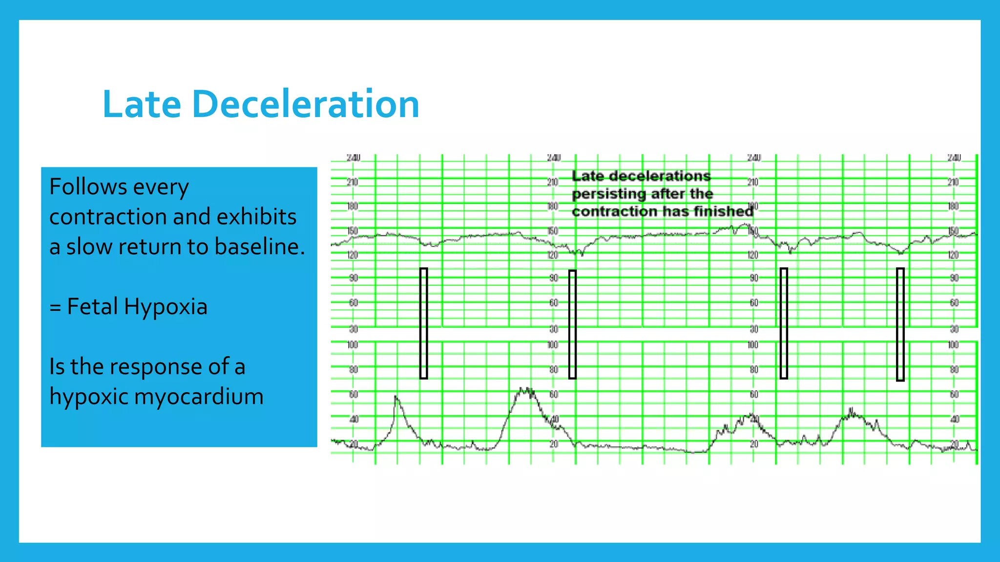 Late Deceleration
Follows every
contraction and exhibits
a slow return to baseline.
= Fetal Hypoxia
Is the response of a
hypoxic myocardium
 