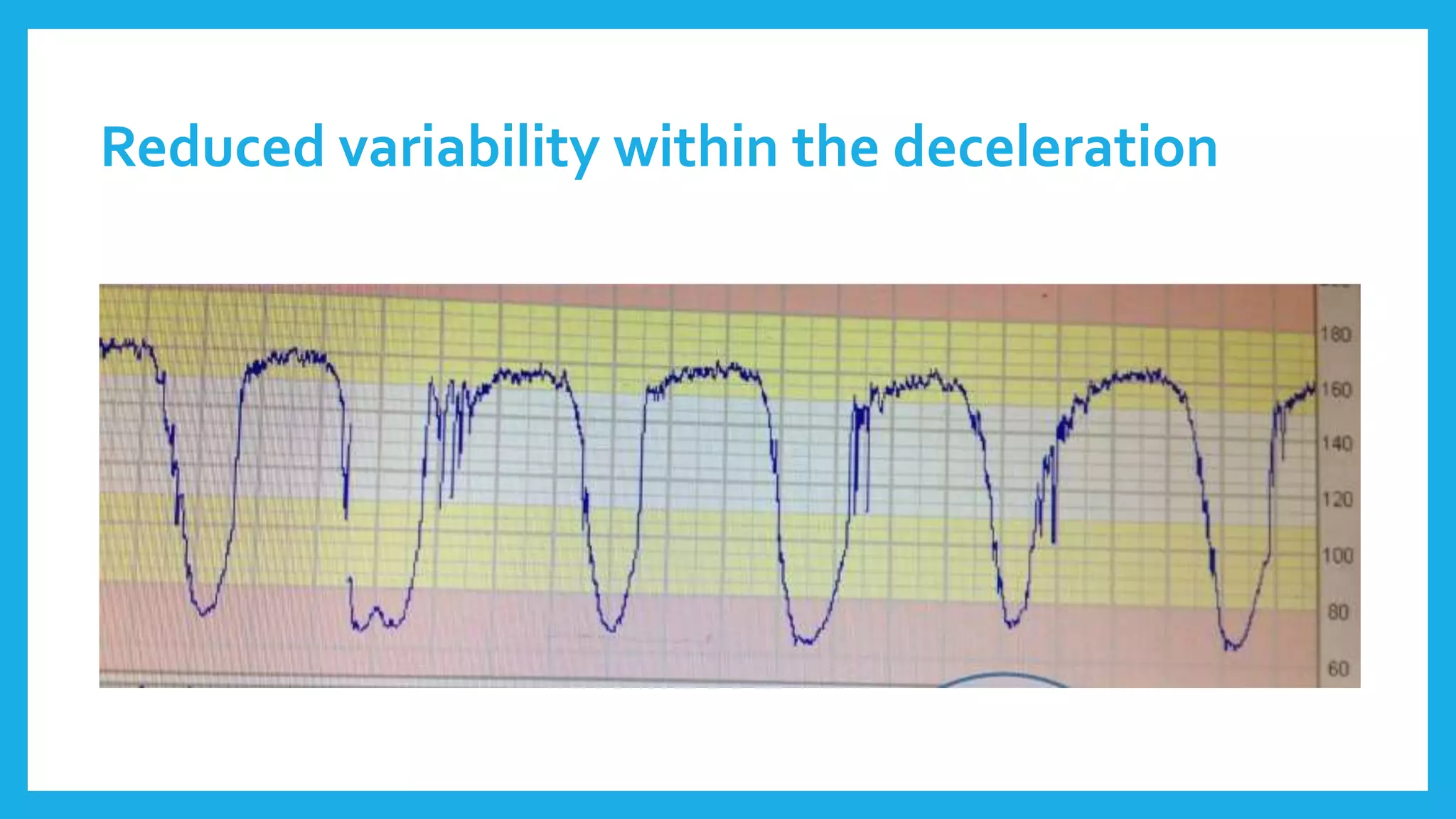 Reduced variability within the deceleration
 