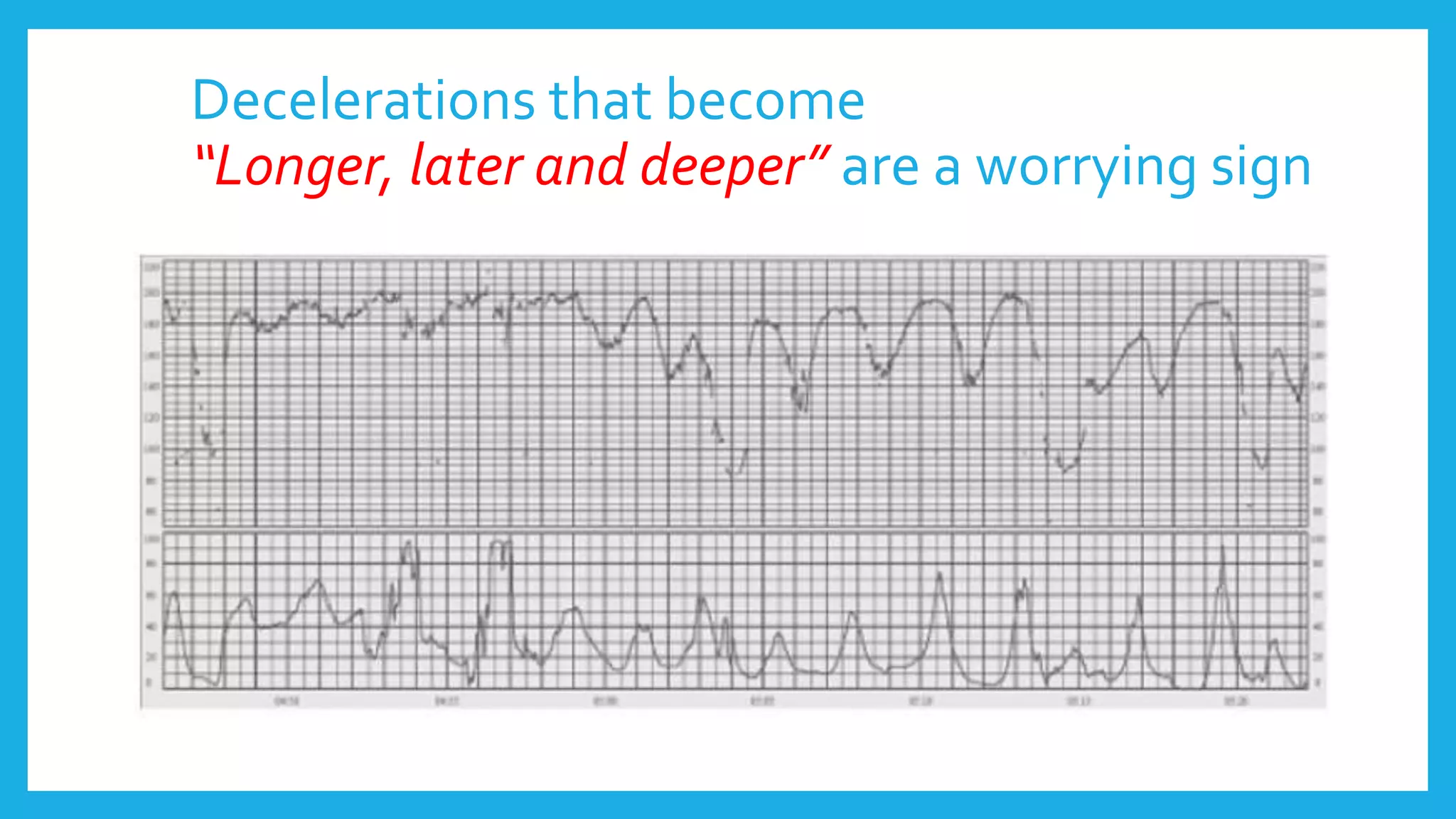 Decelerations that become
“Longer, later and deeper” are a worrying sign
 