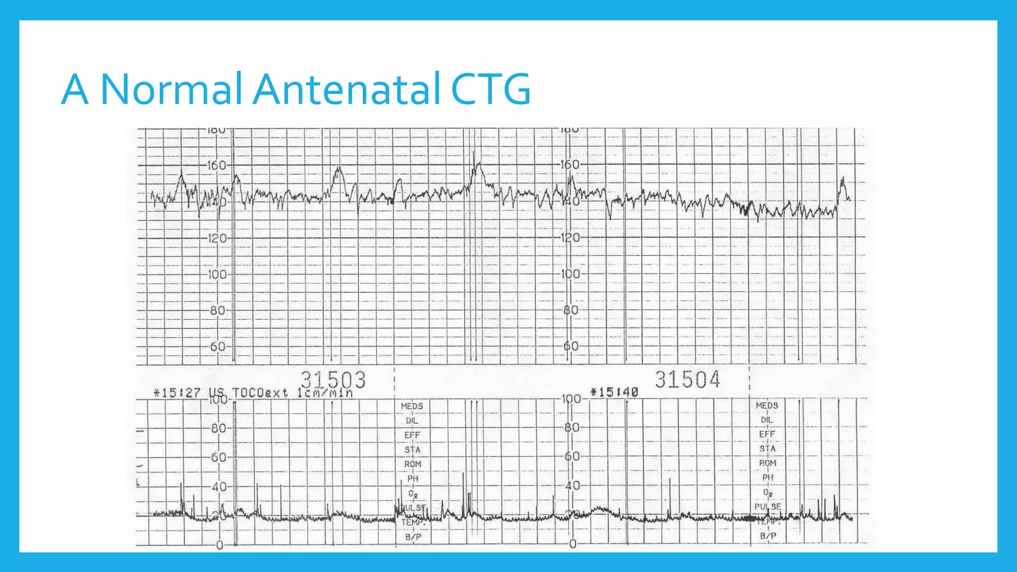 A Normal Antenatal CTG
 