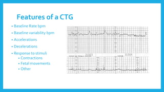Features of a CTG
• Baseline Rate bpm
• Baseline variability bpm
• Accelerations
• Decelerations
• Response to stimuli
• Contractions
• Fetal movements
• Other
 