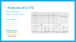 Features of a CTG
• Baseline Rate bpm
• Baseline variability bpm
• Accelerations
• Decelerations
• Response to stimuli
• Contractions
• Fetal movements
• Other
Classified into :
• Reassuring
• Non-reassuring
• Abnormal
 