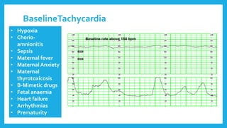 BaselineTachycardia
• Hypoxia
• Chorio-
amnionitis
• Sepsis
• Maternal fever
• Maternal Anxiety
• Maternal
thyrotoxicosis
• B-Mimetic drugs
• Fetal anaemia
• Heart failure
• Arrhythmias
• Prematurity
 