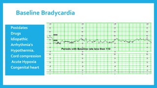 Baseline Bradycardia
• Postdates
• Drugs
• Idiopathic
• Arrhythmia's
• Hypothermia.
• Cord compression
• Acute Hypoxia
• Congenital heart
 