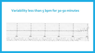 Variability less than 5 bpm for 30-50 minutes
 