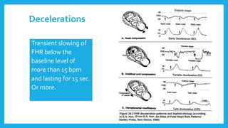 Decelerations
Transient slowing of
FHR below the
baseline level of
more than 15 bpm
and lasting for 15 sec.
Or more.
 