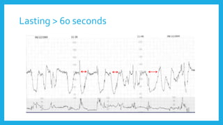 Lasting > 60 seconds
 