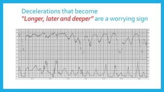 Decelerations that become
“Longer, later and deeper” are a worrying sign
 