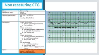 Non reassuring CTG
 
