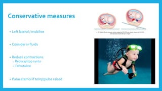 Conservative measures
• Left lateral / mobilise
• Consider iv fluids
• Reduce contractions:
o Reduce/stop synto
o Terbutaline
• Paracetamol if temp/pulse raised
 