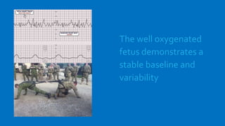 The well oxygenated
fetus demonstrates a
stable baseline and
variability
 